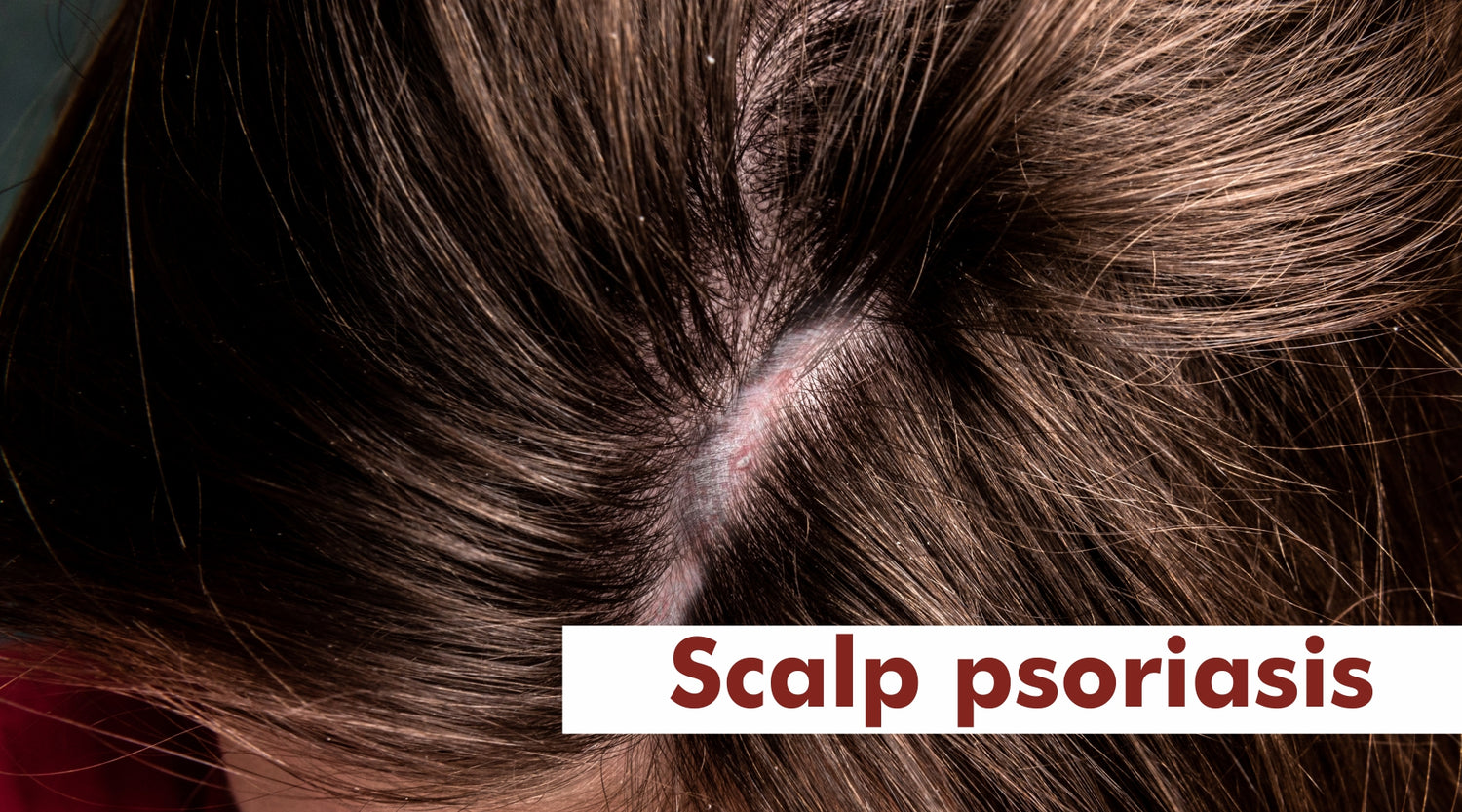Scalp psoriasis management | Effective management for a healthier scalp