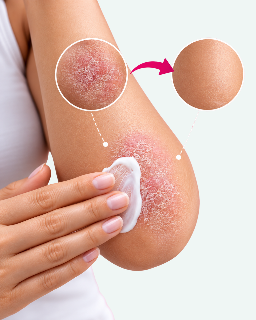 best psoriasis cream