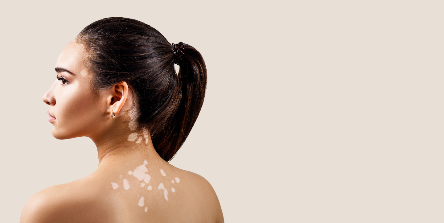  Cream for vitiligo 