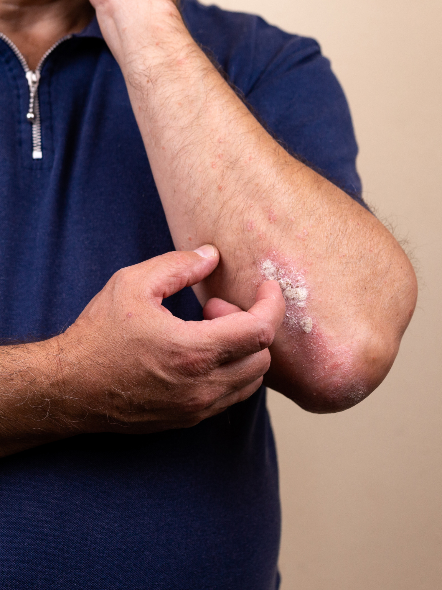 best cream for psoriasis