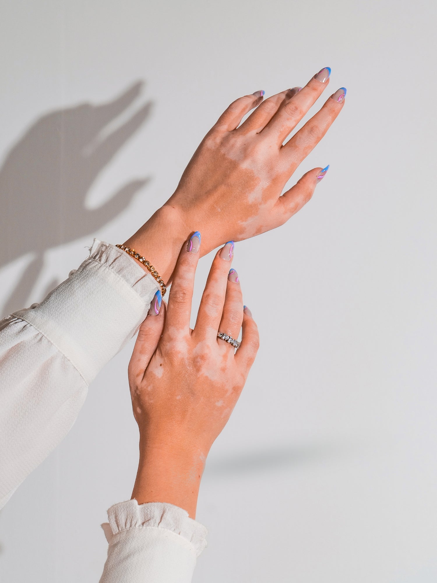 Best vitiligo treatment cream | cream for vitiligo