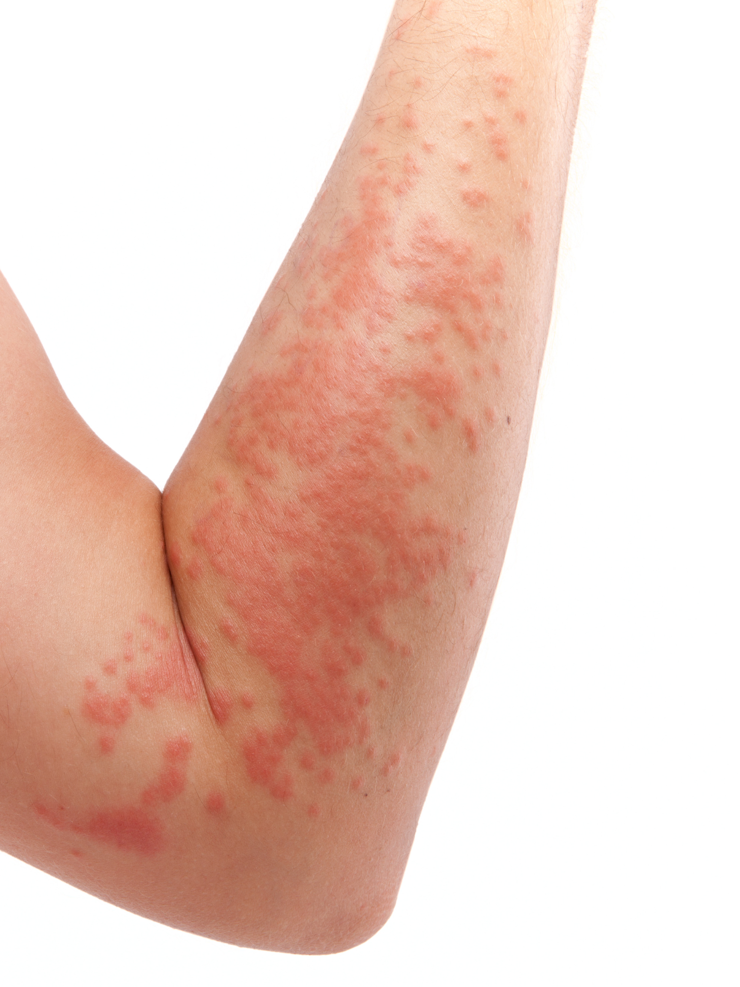 boswell cream for psoriasis