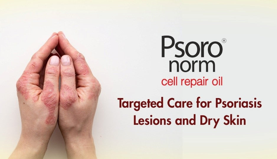 Psoriasis treatment oil