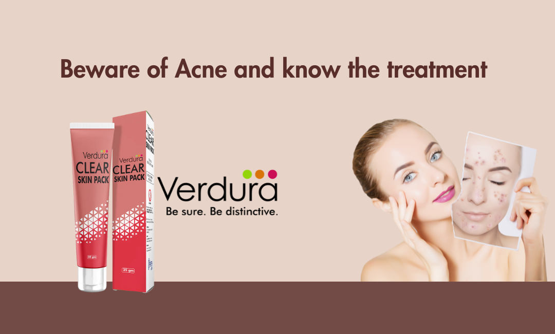 Beware of Acne and know the treatment