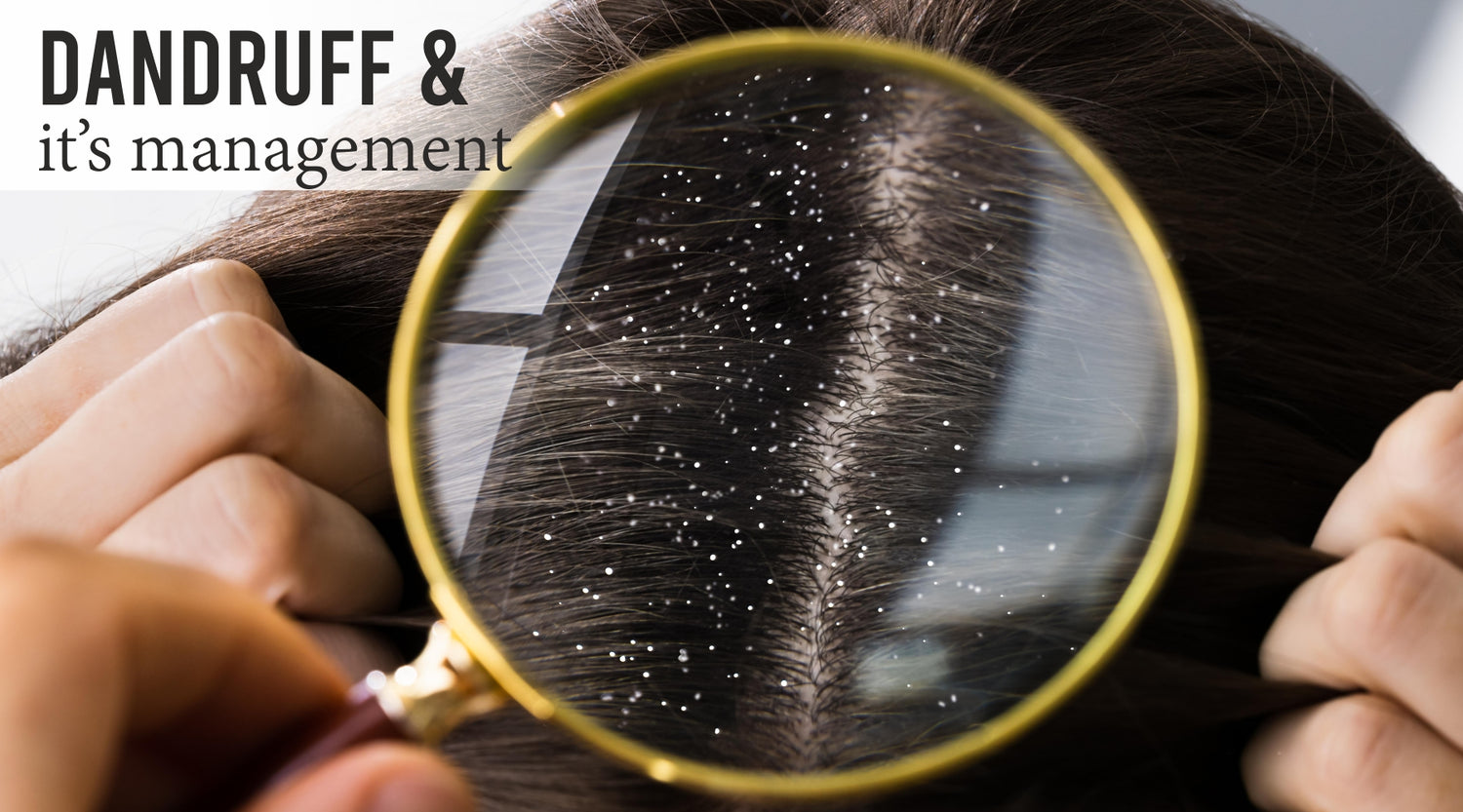 Dandruff and its managements