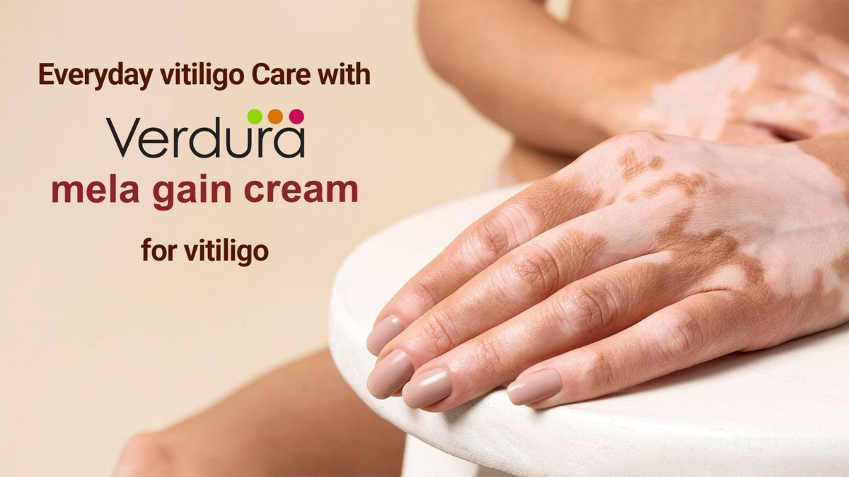 Everyday vitiligo care with verdura mela gain cream for vitiligo